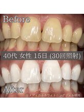 シカホワイトニングトウキョウ 笹塚店(CICA Whitening Tokyo)/ビフォーアフター（40代女性）