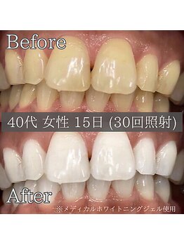 シカホワイトニングトウキョウ 笹塚店(CICA Whitening Tokyo)/ビフォーアフター(40代女性)