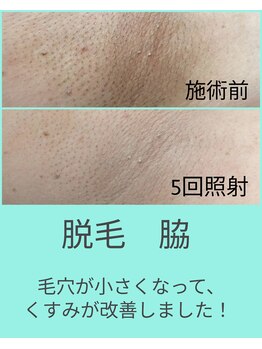 エミナル(EMINAL)/脱毛してお肌がワントーンUP!