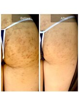 エミルカ(EMILUCA)/ハーブピーリングお尻黒ずみなし