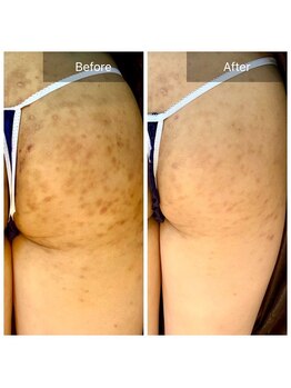 エミルカ(EMILUCA)/ハーブピーリングお尻黒ずみなし