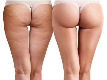 ヨサパーク グランス(YOSA PARK glans)/セル脂肪はルルオンにお任せ！