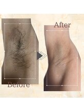 ベル(Belle)/men's脱毛