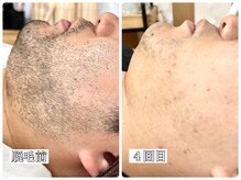 シシエル(CHICIEL)/清潔感UP メンズ脱毛 ヒゲ脱毛