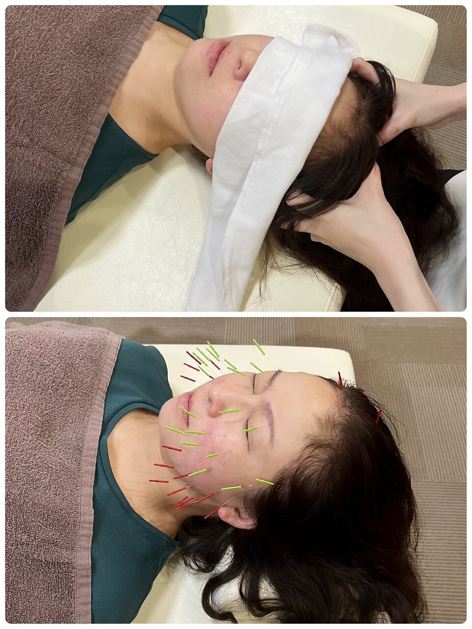 2回目以降の方！美容鍼＋ヘッドマッサージコース　6200円→5200円