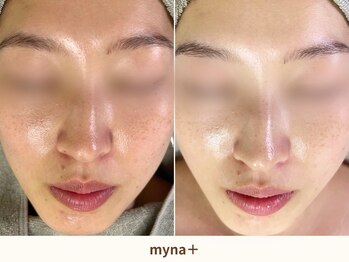 マイナプラ 表参道(myna+)の写真/夏終わりの美白ケア【シミ・くすみ・透明感】イラストリアス美白ピーリング＋ヘッド￥14800-