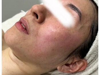 アンドユー ヨコハマ(&U Yokohama)/クリスティーナ施術前