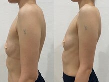 エーアイビューティー 御徒町店(Ai Beauty)/ 【バストアップ例】