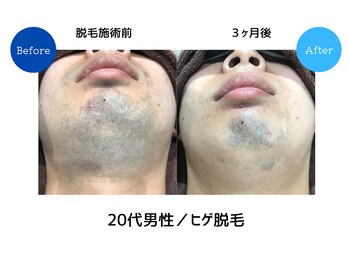 メンズアメリ/高知/メンズ脱毛/ヒゲ/全身/VIO