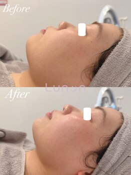 ルノン(Lunon)/【浮腫くすみ】小顔フェイシャル