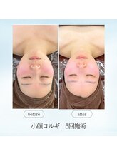 エスプレッソ(espresso,)/衝撃変化の【小顔コルギ】5回