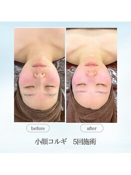 エスプレッソ(espresso,)/衝撃変化の【小顔コルギ】5回