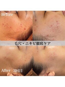 アール アンド ビューティーサロン(Ｒ＆ BeautySalon)/肌質・毛穴徹底改善