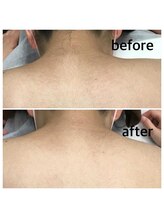 アネモネ(anemone)/ビフォーアフター脱毛の魔法