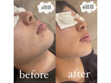 さつき整骨院/ヒゲ脱毛