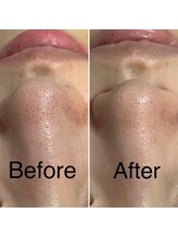 バルダー 原宿 神宮前(BALDER.)/メンズハイドラフェイシャル