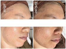 ピリナ 名古屋/【顎ニキビケア症例】名古屋/栄/