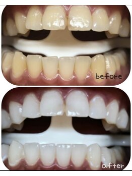 ホワイトニングセンター 浦添市役所前店/那覇市・浦添市・ホワイトニング