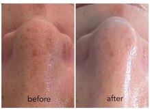 ハリスキンラボ(Hari.Skin.Lab)/40代お客様/1回の施術効果