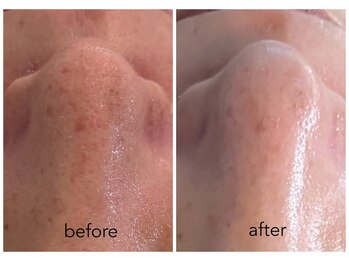 ハリスキンラボ(Hari.Skin.Lab)/40代お客様/1回の施術効果