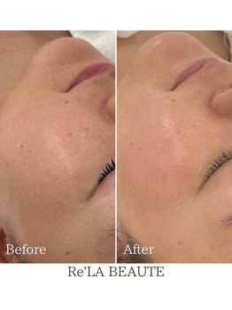 ミエル 神戸店(Miel)/肌質改善トリートメント