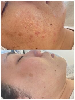 サラシック(salachic)/クールビタミン導入