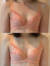 タオ(TAO)/バストアップ症例