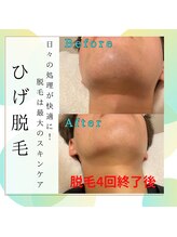 ソラ(SORA)/ヒゲ脱毛4回終了後