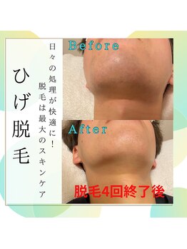 ソラ(SORA)/ヒゲ脱毛4回終了後