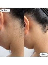 ケトリーナ/10代学生のお客様　うなじ脱毛