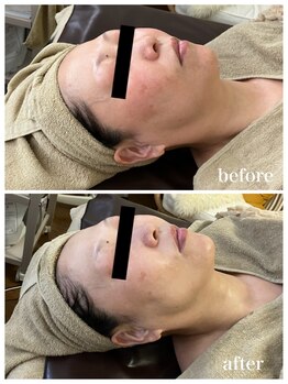 ジャスミン(Jasmin)/たるみ改善コース