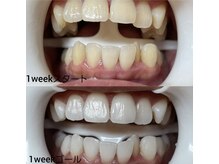 ホワイトニングセンター 浦添市役所前店/那覇市・浦添市・ホワイトニング