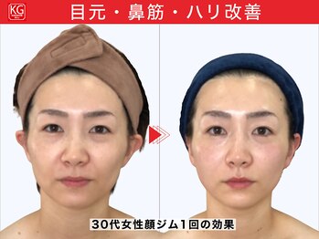 顔ジム 麻布店/30代女性顔ジム1回の効果