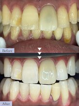 マイレ 平塚店(Maile)/セルフホワイトニング