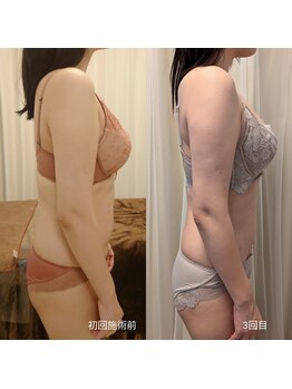 アンドボディ 横浜元町(&Body)/30代後半 バストアップ痩身