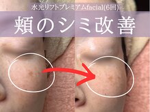 ミトラ(MITRA)