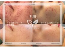 エース(A)の雰囲気（剥離ありor剥離なしハーブピーリングが選べる♪ピーリング専門店）