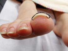 フットケアサロン ラビフット(Rabbi foot)/早目のケア