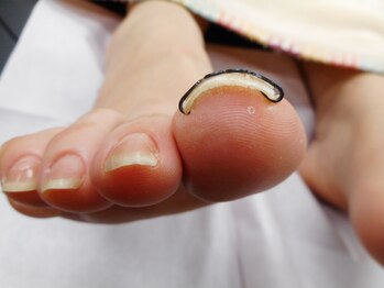 フットケアサロン ラビフット(Rabbi foot)/早目のケア