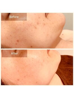 エミルカ(EMILUCA)/ハーブピーリングで顔の悩み改善