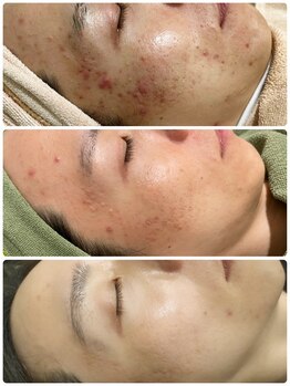 メンズサロンエヌエー(MEN'S SALON NA)/【肌質改善】ハーブピーリング