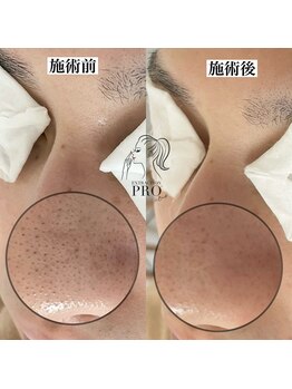 ピュール 鯖江店(PUR)/毛穴サロン/毛穴ケア/毛穴洗浄