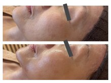 ザ ワン(THE ONE)/植物幹細胞導入