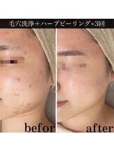 アウラ(AURA)/ニキビがキレイに♪