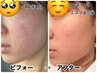 【長年悩んでいた肌荒れ】ニキビ・毛穴・黒ずみケア◎ENVIRONトリートメント