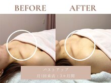 サエラ(SAERA)/光バストアップ【3回】