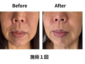 ティアレソワン(tiare soin)/ほうれい線口元たるみ改善