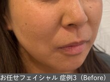 オアシスラグーン(OASIS LAGOON)/お任せフェイシャル（症例3）