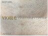 【初回女性】VIO脱毛は痛みが心配？光の調節可能◎ツルツルに￥5,000