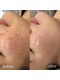 ルラシェ(Relacher)の写真/【繰り返すニキビ・肌荒れ】徹底改善◎肌育ハーブ・美容導入で透明感あふれるツヤ肌へ